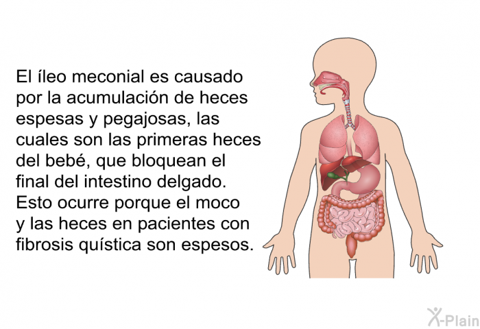 El leo meconial es causado por la acumulacin de heces espesas y pegajosas, las cuales son las primeras heces del beb, que bloquean el final del intestino delgado. Esto ocurre porque el moco y las heces en pacientes con fibrosis qustica son espesos.