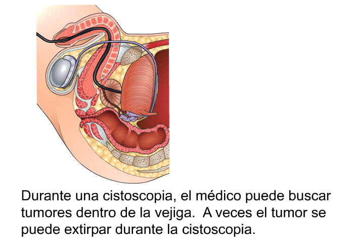 Durante una cistoscopia, el mdico puede buscar tumores dentro de la vejiga. A veces el tumor se puede extirpar durante la cistoscopia.