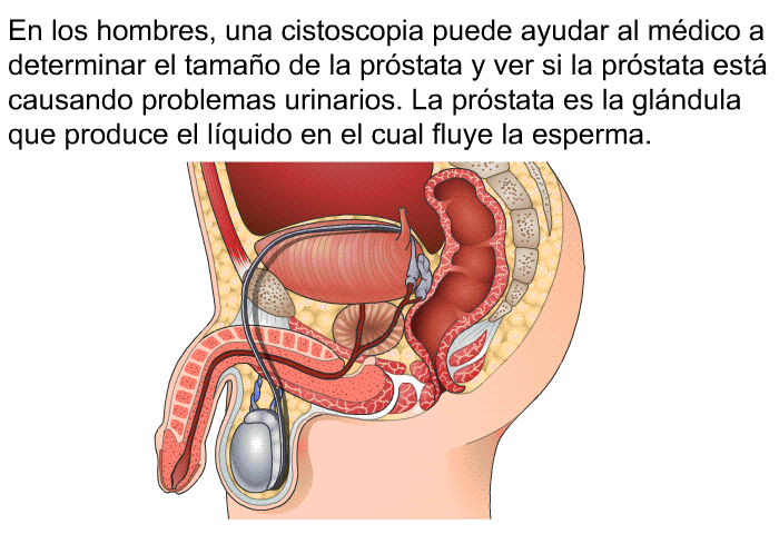 En los hombres, una cistoscopia puede ayudar al mdico a determinar el tamao de la prstata y ver si la prstata est causando problemas urinarios. La prstata es la glndula que produce el lquido en el cual fluye la esperma.