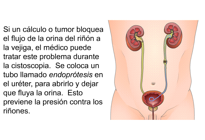 Si un clculo o tumor bloquea el flujo de la orina del rin a la vejiga, el mdico puede tratar este problema durante la cistoscopia. Se coloca un tubo llamado endoprtesis en el urter, para abrirlo y dejar que fluya la orina. Esto previene la presin contra los riones.
