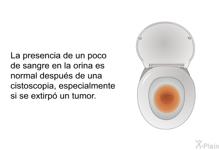 La presencia de un poco de sangre en la orina es normal despus de una cistoscopia, especialmente si se extirp un tumor.