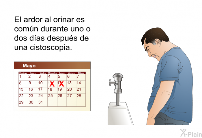 El ardor al orinar es comn durante uno o dos das despus de una cistoscopia.