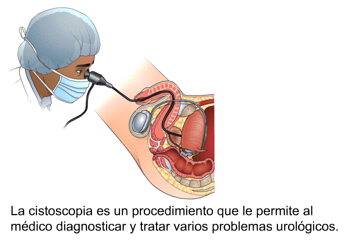 La cistoscopia es un procedimiento que le permite al mdico diagnosticar y tratar varios problemas urolgicos.