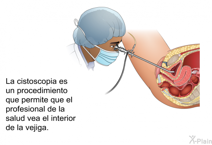 La cistoscopia es un procedimiento que permite que el profesional de la salud vea el interior de la vejiga.