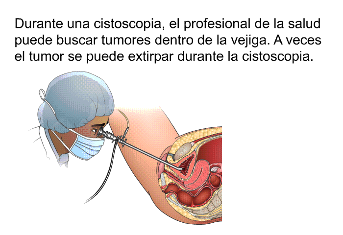 Durante una cistoscopia, el profesional de la salud puede buscar tumores dentro de la vejiga. A veces el tumor se puede extirpar durante la cistoscopia.