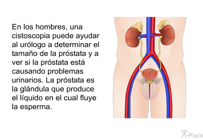 En los hombres, una cistoscopia puede ayudar al urlogo a determinar el tamao de la prstata y a ver si la prstata est causando problemas urinarios. La prstata es la glndula que produce el lquido en el cual fluye la esperma.