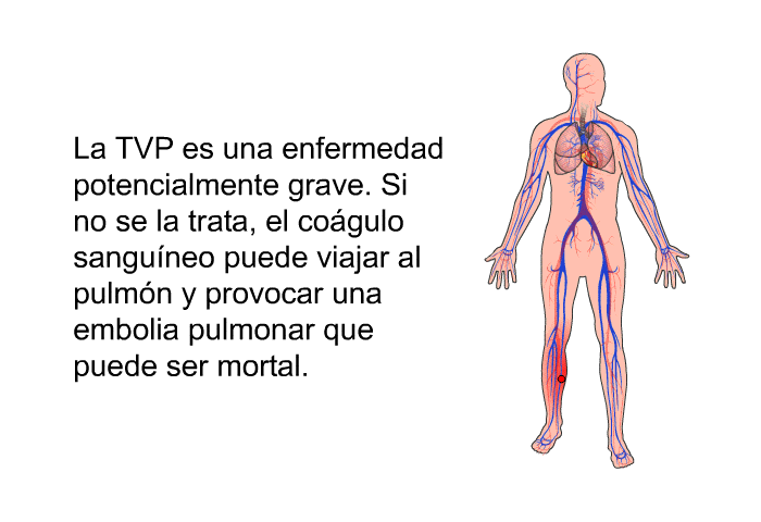 La TVP es una enfermedad potencialmente grave. Si no se la trata, el cogulo sanguneo puede viajar al pulmn y provocar una embolia pulmonar que puede ser mortal.