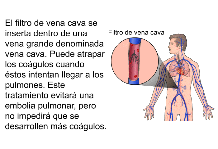 El filtro de vena cava se inserta dentro de una vena grande denominada vena cava. Puede atrapar los cogulos cuando stos intentan llegar a los pulmones. Este tratamiento evitar una embolia pulmonar, pero no impedir que se desarrollen ms cogulos.
