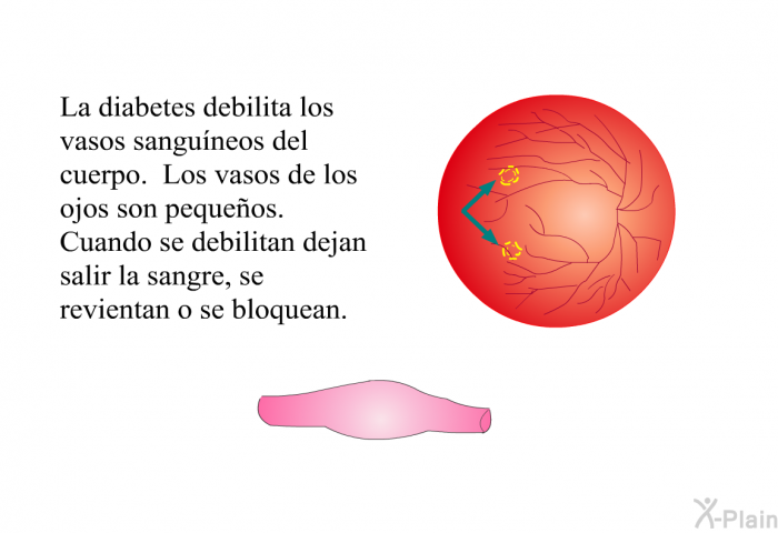 La diabetes debilita los vasos sanguneos del cuerpo. Los vasos de los ojos son pequeos. Cuando se debilitan dejan salir la sangre, se revientan o se bloquean.
