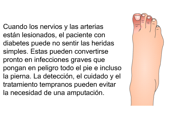 Cuando los nervios y las arterias estn lesionados, el paciente con diabetes puede no sentir las heridas simples. Estas pueden convertirse pronto en infecciones graves que pongan en peligro todo el pie e incluso la pierna. La deteccin, el cuidado y el tratamiento tempranos pueden evitar la necesidad de una amputacin.