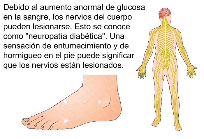 Debido al aumento anormal de glucosa en la sangre, los nervios del cuerpo pueden lesionarse. Esto se conoce como “neuropata diabtica”. Una sensacin de entumecimiento y de hormigueo en el pie puede significar que los nervios estn lesionados.