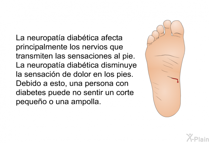 La neuropata diabtica afecta principalmente los nervios que transmiten las sensaciones al pie. La neuropata diabtica disminuye la sensacin de dolor en los pies. Debido a esto, una persona con diabetes puede no sentir un corte pequeo o una ampolla.