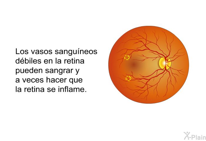 Los vasos sanguneos dbiles en la retina pueden sangrar y a veces hacer que la retina se inflame.