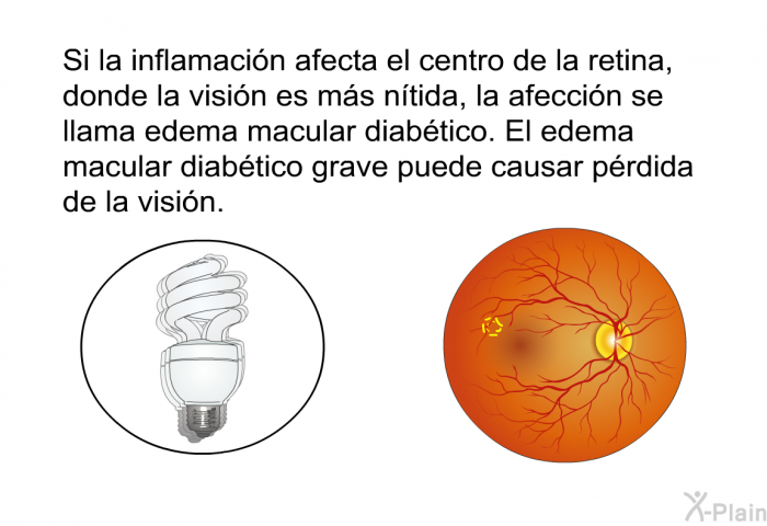 Si la inflamacin afecta el centro de la retina, donde la visin es ms ntida, la afeccin se llama edema macular diabtico. El edema macular diabtico grave puede causar prdida de la visin.