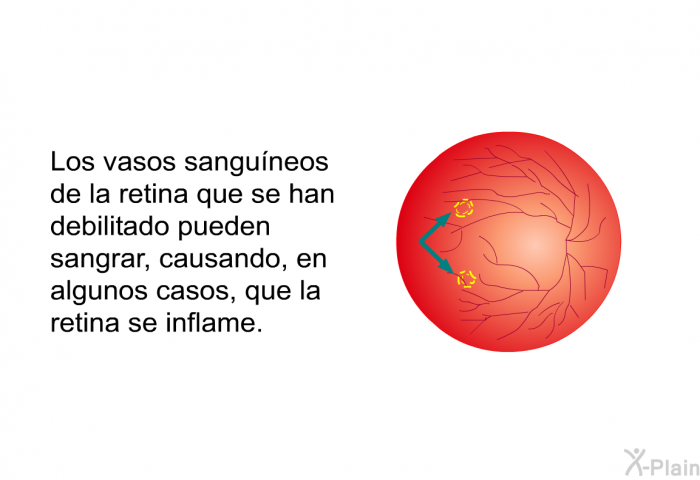 Los vasos sanguneos de la retina que se han debilitado pueden sangrar, causando, en algunos casos, que la retina se inflame.