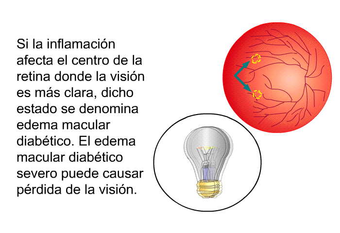 Si la inflamacin afecta el centro de la retina donde la visin es ms clara, dicho estado se denomina edema macular diabtico. El edema macular diabtico severo puede causar prdida de la visin.