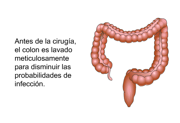 Antes de la ciruga, el colon es lavado meticulosamente para disminuir las probabilidades de infeccin.