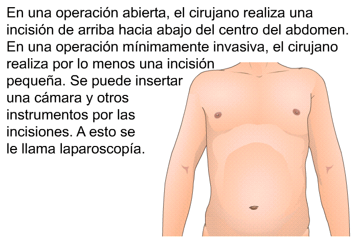 En una operacin abierta, el cirujano realiza una incisin de arriba hacia abajo del centro del abdomen. En una operacin mnimamente invasiva, el cirujano realiza por lo menos una incisin pequea. Se puede insertar una cmara y otros instrumentos por las incisiones. A esto se le llama laparoscopa.