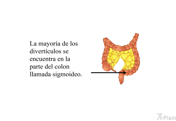 La mayora de los divertculos se encuentra en la parte del colon llamada sigmoideo.