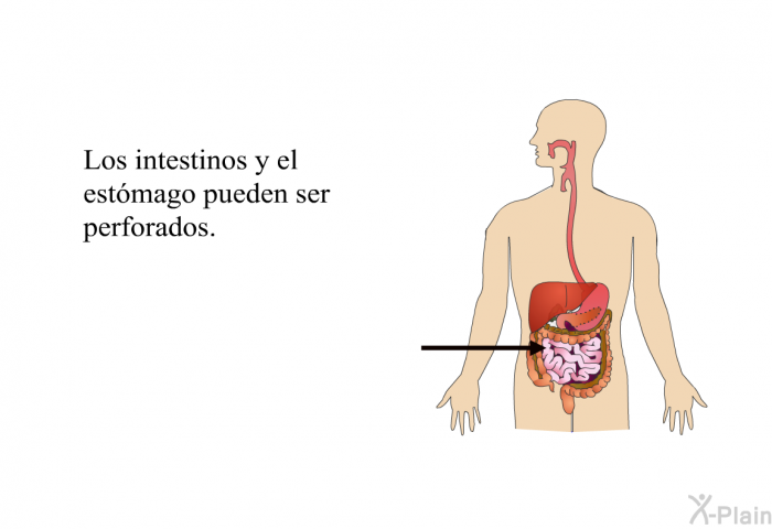 Los intestinos y el estmago pueden ser perforados.