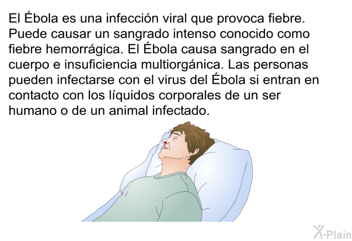El Ébola es una infeccin viral que provoca fiebre. Puede causar un sangrado intenso conocido como fiebre hemorrgica. El Ébola causa sangrado en el cuerpo e insuficiencia multiorgnica. Las personas pueden infectarse con el virus del Ébola si entran en contacto con los lquidos corporales de un ser humano o de un animal infectado.
