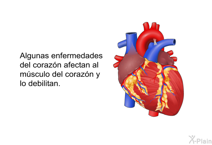 Algunas enfermedades del corazn afectan al msculo del corazn y lo debilitan.