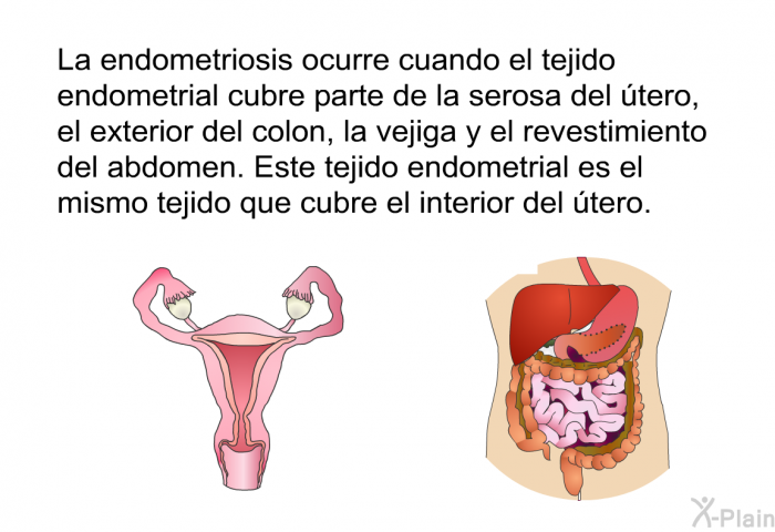 La endometriosis ocurre cuando el tejido endometrial cubre parte de la serosa del tero, el exterior del colon, la vejiga y el revestimiento del abdomen. Este tejido endometrial es el mismo tejido que cubre el interior del tero.