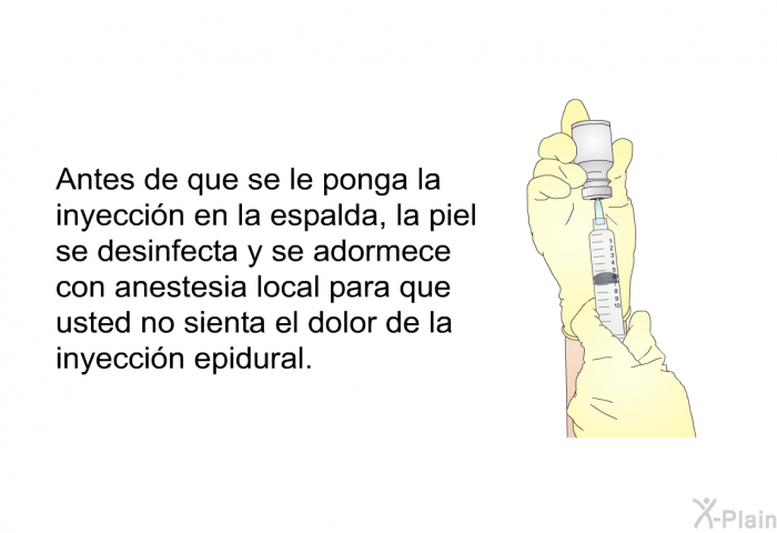 Antes de que se le ponga la inyeccin en la espalda, la piel se desinfecta y se adormece con anestesia local para que usted no sienta el dolor de la inyeccin epidural.