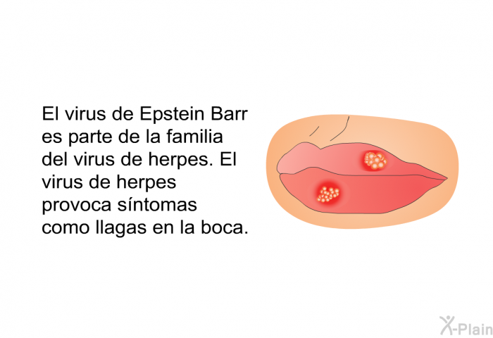 El virus de Epstein Barr es parte de la familia del virus de herpes. El virus de herpes provoca sntomas como llagas en la boca.