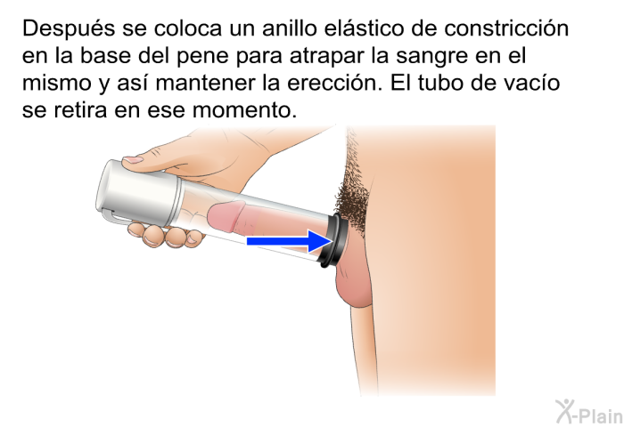 Despu�s se coloca un anillo el�stico de constricci�n en la base del pene para atrapar la sangre en el mismo y as� mantener la erecci�n. El tubo de vac�o se retira en ese momento.