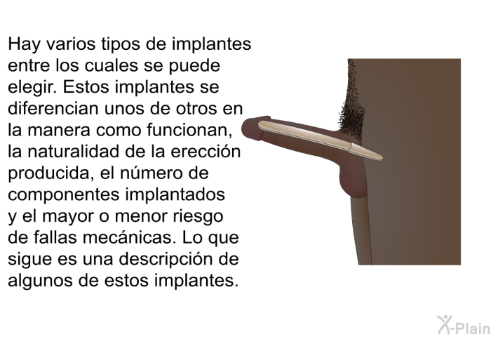 Hay varios tipos de implantes entre los cuales se puede elegir. Estos implantes se diferencian unos de otros en la manera como funcionan, la naturalidad de la erecci�n producida, el n�mero de componentes implantados y el mayor o menor riesgo de fallas mec�nicas. Lo que sigue es una descripci�n de algunos de estos implantes.