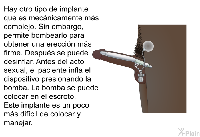 Hay otro tipo de implante que es mec�nicamente m�s complejo. Sin embargo, permite bombearlo para obtener una erecci�n m�s firme. Despu�s se puede desinflar. Antes del acto sexual, el paciente infla el dispositivo presionando la bomba. La bomba se puede colocar en el escroto. Este implante es un poco m�s dif�cil de colocar y manejar.