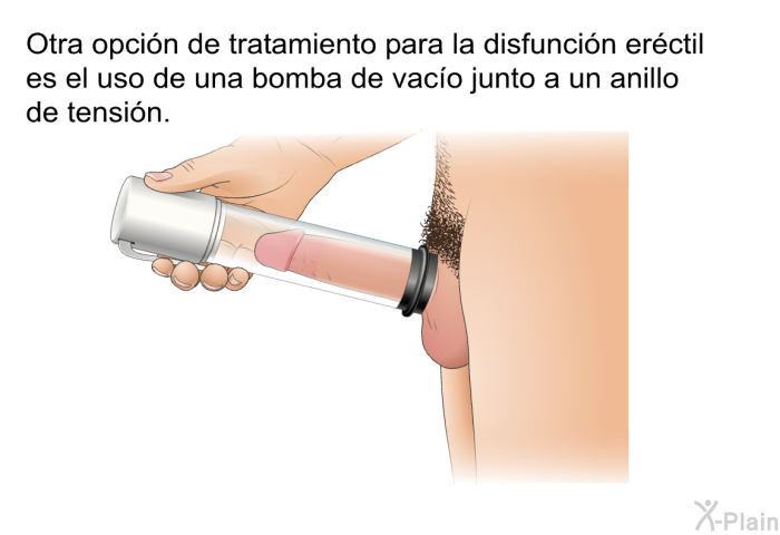 Otra opci�n de tratamiento para la disfunci�n er�ctil es el uso de una bomba de vac�o junto a un anillo de tensi�n.