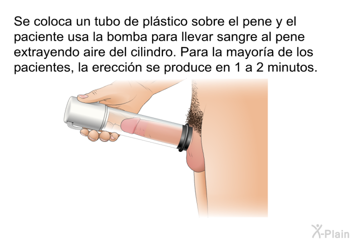 Se coloca un tubo de pl�stico sobre el pene y el paciente usa la bomba para llevar sangre al pene extrayendo aire del cilindro. Para la mayor�a de los pacientes, la erecci�n se produce en 1 a 2 minutos.