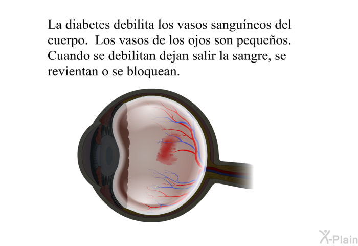 La diabetes debilita los vasos sanguneos del cuerpo. Los vasos de los ojos son pequeos. Cuando se debilitan dejan salir la sangre, se revientan o se bloquean.