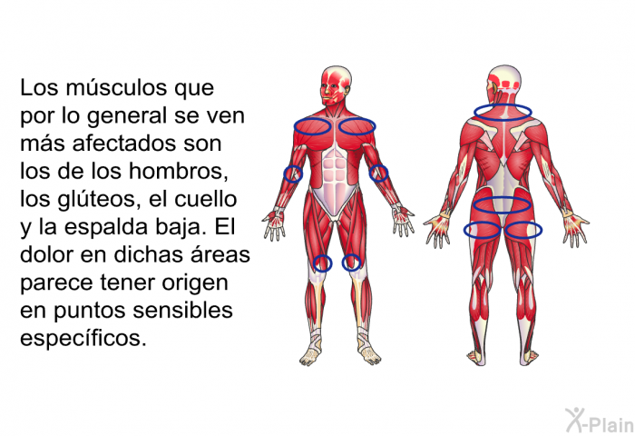 Los msculos que por lo general se ven ms afectados son los de los hombros, los glteos, el cuello y la espalda baja. El dolor en dichas reas parece tener origen en puntos sensibles especficos.