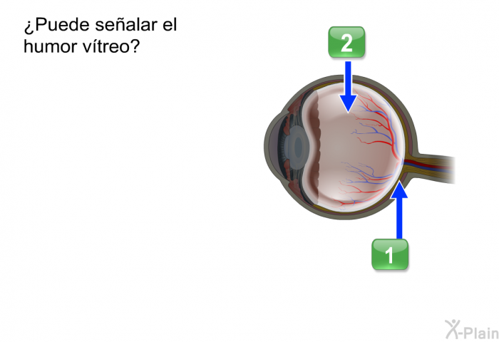 ¿Puede sealar el humor vtreo?