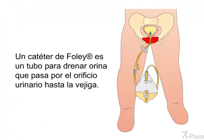 Un catter de Foley<SUP> </SUP> es un tubo para drenar orina que pasa por el orificio urinario hasta la vejiga.