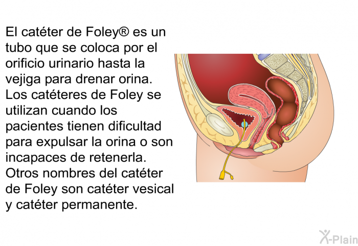 El cat�ter de Foley<SUP> </SUP> es un tubo que se coloca por el orificio urinario hasta la vejiga para drenar orina. Los cat�teres de Foley se utilizan cuando los pacientes tienen dificultad para expulsar la orina o son incapaces de retenerla. Otros nombres del cat�ter de Foley son cat�ter vesical y cat�ter permanente.