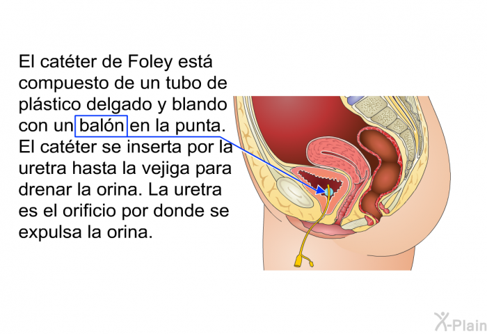 El catter de Foley est compuesto de un tubo de plstico delgado y blando con un baln en la punta. El catter se inserta por la uretra hasta la vejiga para drenar la orina. La uretra es el orificio por donde se expulsa la orina.