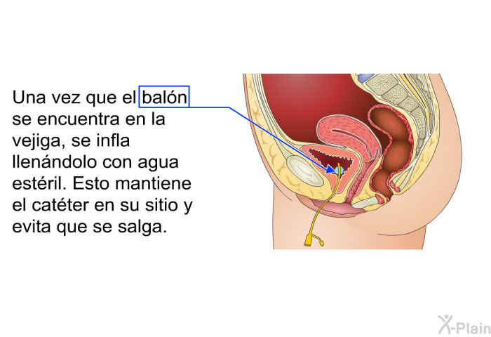 Una vez que el baln se encuentra en la vejiga, se infla llenndolo con agua estril. Esto mantiene el catter en su sitio y evita que se salga.