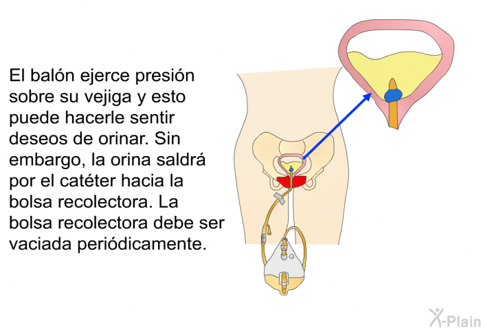 El baln ejerce presin sobre su vejiga y esto puede hacerle sentir deseos de orinar. Sin embargo, la orina saldr por el catter hacia la bolsa recolectora. La bolsa recolectora debe ser vaciada peridicamente.