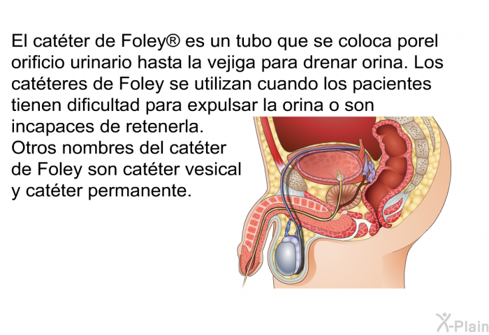 El cat�ter de Foley<SUP> </SUP> es un tubo que se coloca porel orificio urinario hasta la vejiga para drenar orina. Los cat�teres de Foley se utilizan cuando los pacientes tienen dificultad para expulsar la orina o son incapaces de retenerla. Otros nombres del cat�ter de Foley son cat�ter vesical y cat�ter permanente.