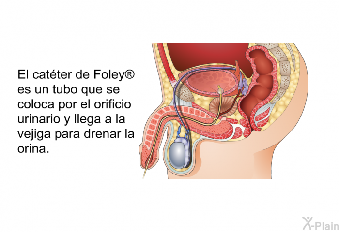 El catter de Foley<SUP> </SUP> es un tubo que se coloca por el orificio urinario y llega a la vejiga para drenar la orina.