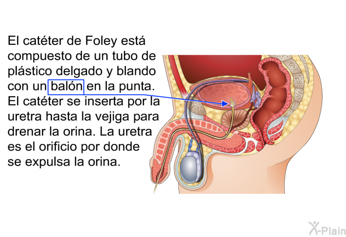 El catter de Foley est compuesto de un tubo de plstico delgado y blando con un baln en la punta. El catter se inserta por la uretra hasta la vejiga para drenar la orina. La uretra es el orificio por donde se expulsa la orina.