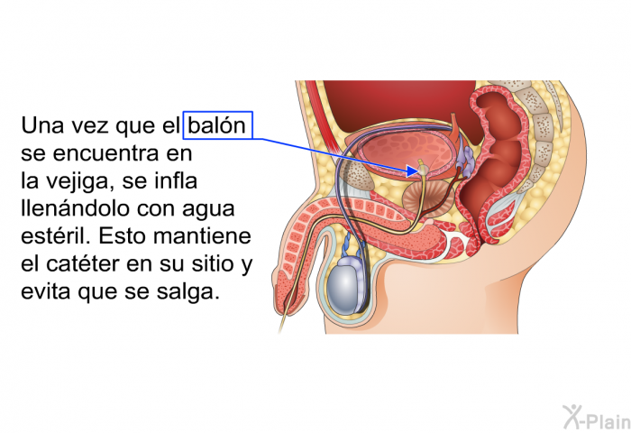 Una vez que el baln se encuentra en la vejiga, se infla llenndolo con agua estril. Esto mantiene el catter en su sitio y evita que se salga.