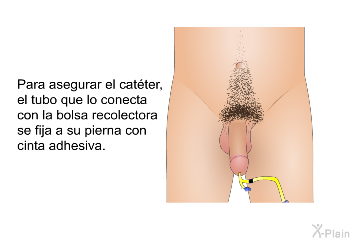 Para asegurar el catter, el tubo que lo conecta con la bolsa recolectora se fija a su pierna con cinta adhesiva.