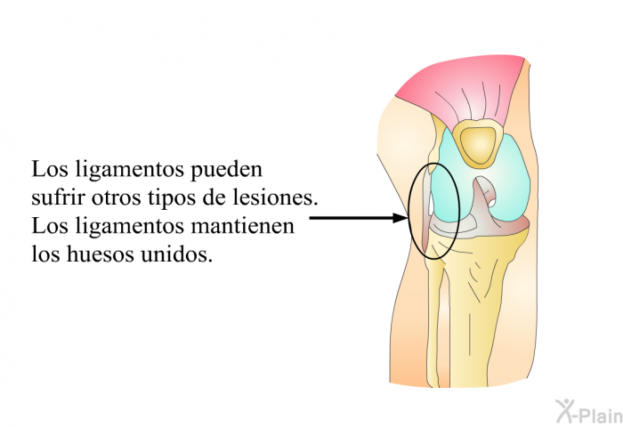 Los ligamentos pueden sufrir otros tipos de lesiones. Los ligamentos mantienen los huesos unidos.