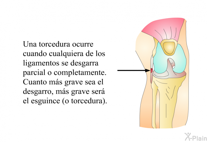 Una torcedura ocurre cuando cualquiera de los ligamentos se desgarra parcial o completamente. Cuanto ms grave sea el desgarro, ms grave ser el esguince (o torcedura).