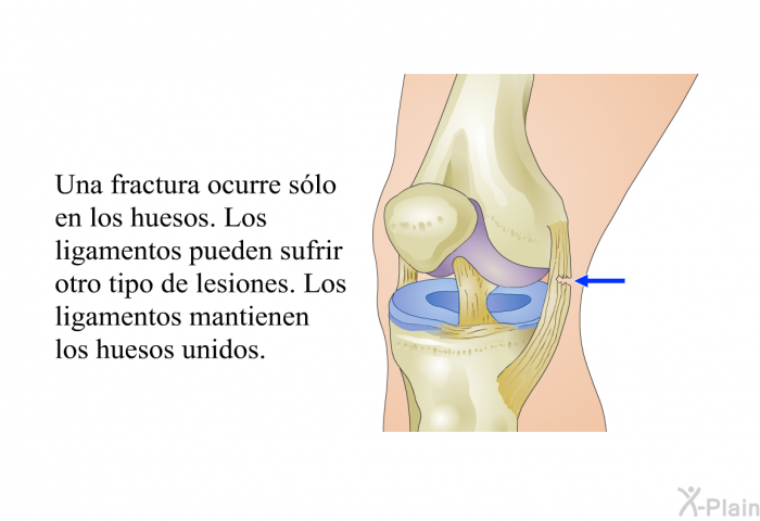 Una fractura ocurre slo en los huesos. Los ligamentos pueden sufrir otro tipo de lesiones. Los ligamentos mantienen los huesos unidos.